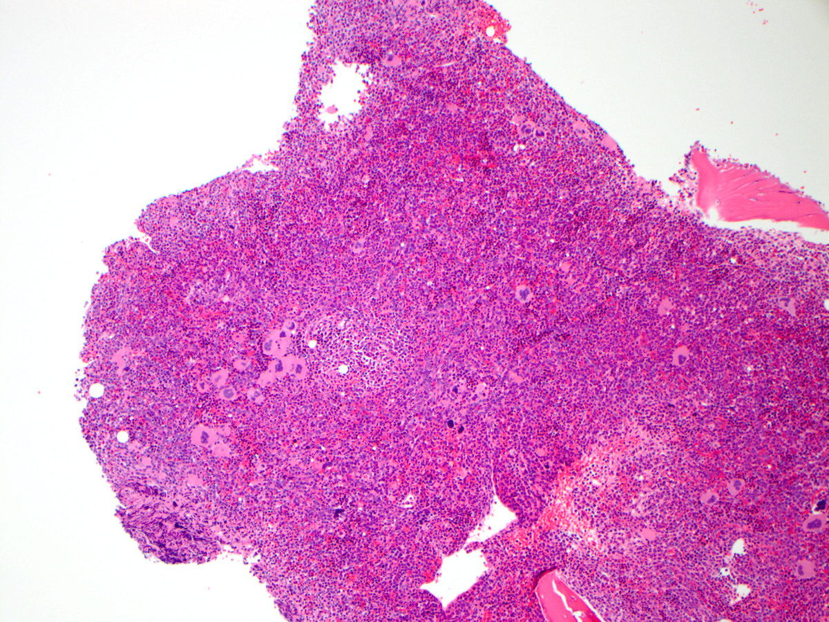 Low power view of bone marrow biopsy showing hypercellular marrow and clustering of abnormal megakaryocytes.